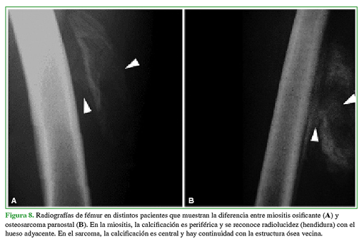 Radiografías de fémur en distintos pacientes que muestran la diferencia entre miositis osificante (A) y osteosarcoma paraostal (B). En la miositis, la calcificación es periférica y se reconoce radiolucidez (hendidura) con el hueso adyacente. En el sarcoma, la calcificación es central y hay continuidad con la estructura ósea vecina. 