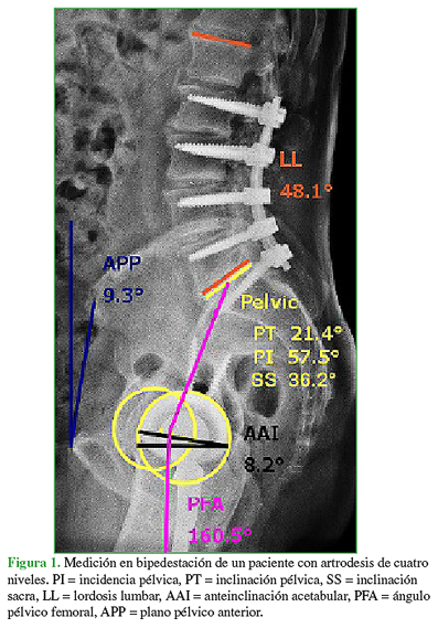 Medición en bipedestación de un paciente con artrodesis de cuatro niveles. PI = incidencia pélvica, PT = inclinación pélvica, SS = inclinación sacra, LL = lordosis lumbar, AAI = anteinclinación acetabular, PFA = ángulo pélvico femoral, APP = plano pélvico anterior.
