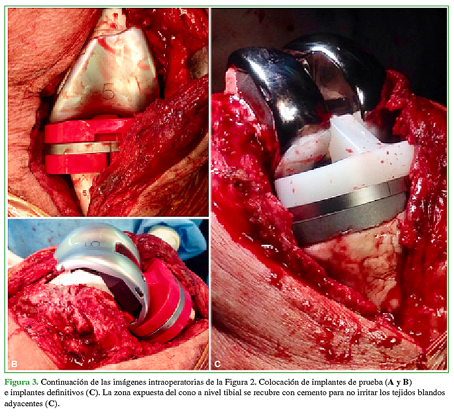 Continuación de las imágenes intraoperatorias de la Figura 2. Colocación de implantes de prueba (A y B) e implantes definitivos (C). La zona expuesta del cono a nivel tibial se recubre con cemento para no irritar los tejidos blandos adyacentes (C).  