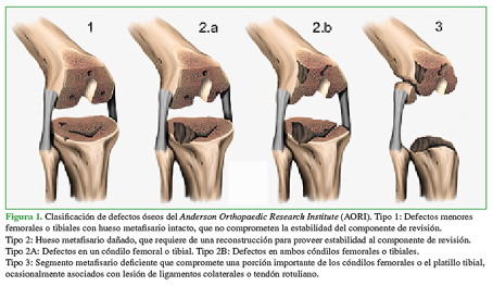Clasificación de defectos óseos del Anderson Orthopaedic Research Institute (AORI). Tipo 1: Defectos menores femorales o tibiales con hueso metafisario intacto, que no comprometen la estabilidad del componente de revisión. Tipo 2: Hueso metafisario dañado, que requiere de una reconstrucción para proveer estabilidad al componente de revisión. Tipo 2A: Defectos en un cóndilo femoral o tibial. Tipo 2B: Defectos en ambos cóndilos femorales o tibiales. Tipo 3: Segmento metafisario deficiente que compromete una porción importante de los cóndilos femorales o el platillo tibial ocasionalmente asociados con lesión de ligamentos colaterales o tendón rotuliano. 