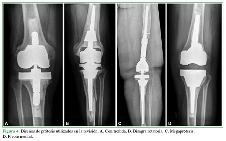 Diseños de prótesis utilizados en la revisión. A. Constreñida. B. Bisagra rotatoria. C. Megaprótesis, D. Pivote medial. 