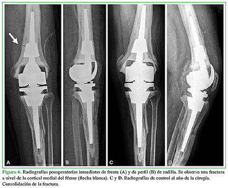 Radiografías posoperatorias inmediatas de frente (A) y de perfil (B) de rodilla. Se observa una fractura a nivel cortical medial del fémur (flecha blanca). C y D. Radiografías de control al año de la cirugía. Consolidación de la fractura. 