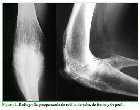 Radiografía preoperatoria de rodilla derecha, de frente y de perfil.