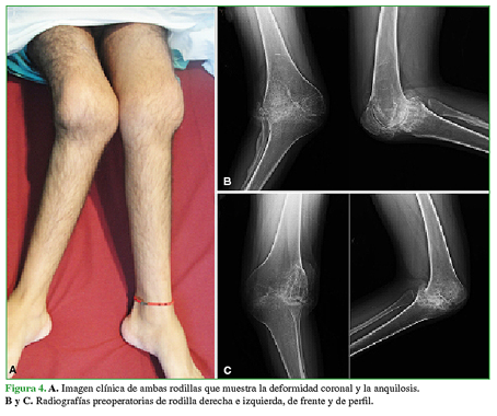 A. Imagen clínica de ambas rodillas que muestra la deformidad coronal y la anquilosis. B y C. Radiografías preoperatorias de rodilla derecha e izquierda, de frente y de perfil.
