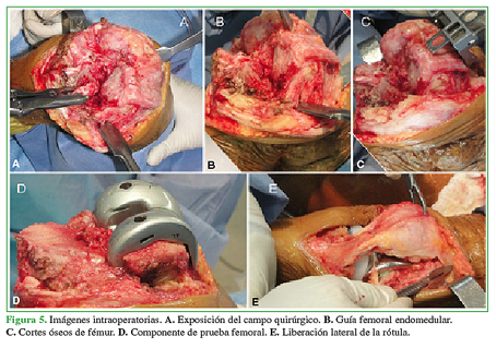 Imágenes intraoperatorias. A. Exposición del campo quirúrgico. B. Guía femoral endomedular. C. Cortes óseos de fémur. D. Componente de prueba femoral. E. Liberación lateral de la rótula. 