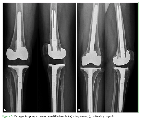 Radiografías posoperatorias de rodilla derecha (A) e izquierda (B), de frente y de perfil.