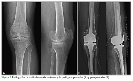 Radiografías de rodilla izquierda, de frente y de perfil, preoperatorias (A) y posoperatorias (B).