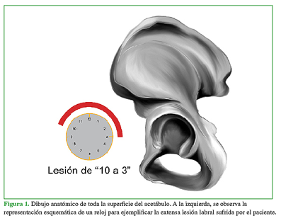 Dibujo anatómico de toda la superficie del acetábulo. A la izquierda, se observa la representación esquemática de un reloj para ejemplificar la extensa lesión labral sufrida por el paciente.
