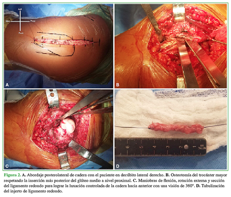 A. Abordaje posterolateral de cadera con el paciente en decúbito lateral derecho. B. Osteotomía del trocánter mayor respetando la inserción más posterior del glúteo medio a nivel proximal. C. Maniobras de flexión, rotación externa y sección del ligamento redondo para lograr la luxación controlada de la cadera hacia anterior con una visión de 360°. D. Tubulización del injerto de ligamento redondo. 