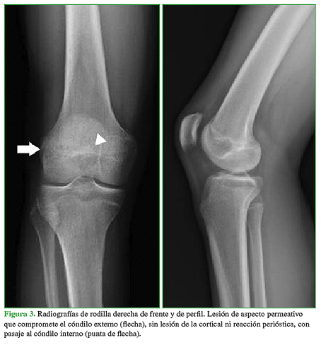 Radiografías de rodilla derecha de frente y de perfil. Lesión de aspecto permeativo que compromete el cóndilo externo (flecha), sin lesión de la cortical ni reacción perióstica, con pasaje al cóndilo interno (punta de flecha). 