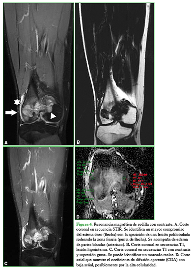 Resonancia magnética de rodilla con contraste. A. Corte coronal en secuencia STIR. Se identifica un mayor compromiso del edema óseo (flecha) con la aparición de una lesión polilobulada rodeando la zona fisaria (punta de flecha). Se acompaña de edema de partes blandas (asterisco). B. Corte coronal en secuencias T1, lesión hipointensa. C. Corte coronal en secuencias T1 con contraste y supresión grasa. Se puede identificar un marcado realce. D. Corte axial que muestra el coeficiente de difusión aparente (CDA) con  baja señal, posiblemente por la alta celularidad.