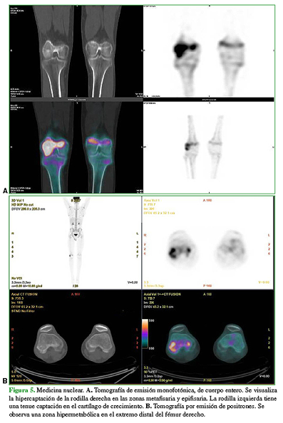 Medicina nuclear. A. Tomografía de emisión monofotónica, de cuerpo entero. Se visualiza la hipercaptación de la rodilla derecha en las zonas metafisaria y epifisaria. La rodilla izquierda tiene una tenue captación en el cartílago de crecimiento. B. Tomografía por emisión de positrones. Se observa una zona hipermetabólica en el extremo distal del fémur derecho.