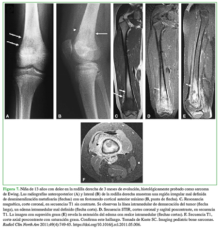 Niña de 13 años con dolor en la rodilla derecha de 3 meses de evolución, histológicamente probado como sarcoma de Ewing. Las radiografías anteroposterior (A) y lateral (B) de la rodilla derecha muestran una región irregular mal definida de desmineralización metafisaria (flechas) con un festoneado cortical anterior mínimo (B, punta de flecha). C. Resonancia magnética, corte coronal, en secuencias T1 sin contraste. Se observan la línea intramedular de demarcación del tumor (flecha larga), un edema intramedular mal definido (flecha corta). D. Secuencia STIR, cortes coronal y sagital poscontraste, en secuencia T1. La imagen con supresión grasa (E) revela la extensión del edema con realce intramedular (flechas cortas). F. Secuencia T1, corte axial poscontraste con saturación grasa. Confirma este hallazgo. Tomada de Kaste SC. Imaging pediatric bone sarcomas. Radiol Clin North Am 2011:49(4):749-65. https://doi.org/10.1016/j.rcl.2011.05.006. 