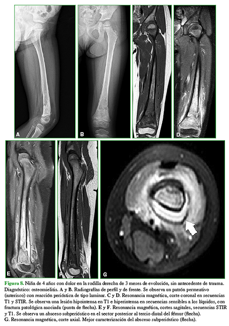 Niña de 4 años con dolor de rodilla derecha de 3 meses de evolución, sin antecedente de trauma. Diagnóstico: osteomielitis. A y B. Radiografías de perfil y de frente. Se observa un patrón permeativo (asterisco) con reacción perióstica de tipo laminar.  C y D. Resonancia magnética, corte coronal en secuencias T1 y STIR. Se observa una lesión hipointensa en T1 e hiperintensa en secuencias sensibles a los líquidos, con fractura patológica asociada (punta de flecha). E y F. Resonancia magnética, cortes sagitales, secuencias STIR y T1. Se observa un absceso subperióstico en el sector posterior al tercio distal del fémur (flecha). G. Resonancia magnética, corte axial. Mejor caracterización del absceso subperióstico (flecha). 