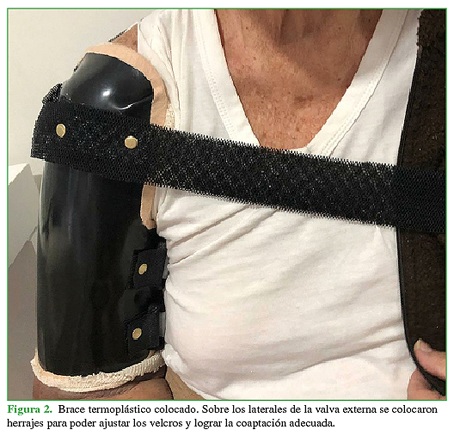 Brace termoplástico colocado. Sobre los laterales de la valva externa se colocaron herrajes para poder ajustar los velcros y lograr la coaptación adecuada. 
