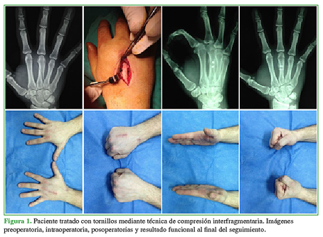 Paciente tratado con tornillos mediante técnica de compresión interfragmentaria. Imágenes preoperatoria, intraoperatoria, posoperatorias, y resultado funcional al final del seguimiento.