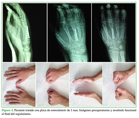Paciente tratado con placa de osteosíntesis de 2 mm. Imágenes posoperatorias y resultado funcional al final del seguimiento.