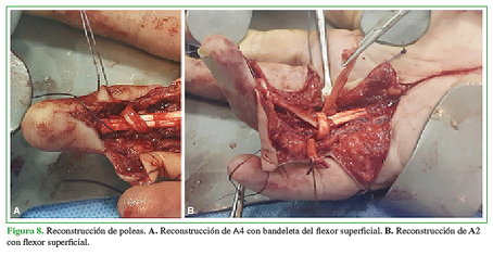 Reconstrucción de poleas. A. Reconstrucción de A4 con bandeleta del flexor superficial. B. Reconstrucción de A2 con flexor superficial.