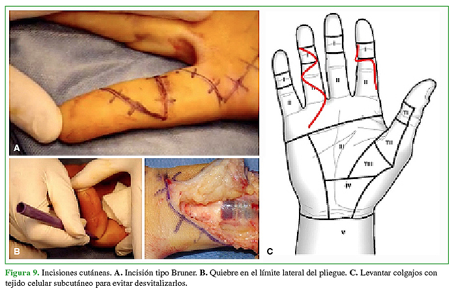 Incisiones cutáneas. A. Incisión tipo Bruner. B. Quiebre en el límite lateral del pliegue. C. Levantar colgajos con tejido celular subcutáneo para evitar desvitalizarlos.