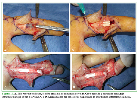 A. Si la víncula está sana, el cabo proximal se encuentra cerca. B. Cabo pescado y sostenido con aguja intramuscular que lo fija a la vaina. C y D.  Acercamiento del cabo distal flexionando la articulación interfalángica distal.