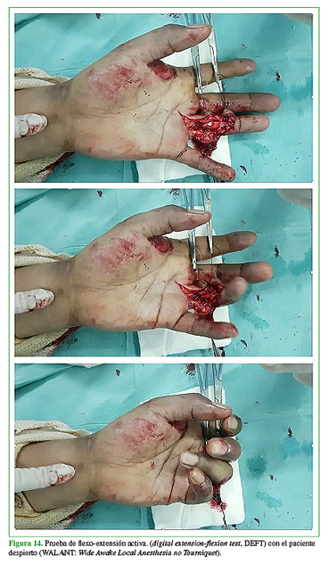Prueba de flexo-extensión activa. (digital extension-flexion test, DEFT) con el paciente despierto (WALANT: Wide Awake Local Anesthesia no Tourniquet).