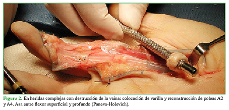 En heridas complejas con destrucción de la vaina: colocación de varilla y reconstrucción de poleas A2 y A4. Asa entre flexor superficial y profundo (Paneva-Holevich).