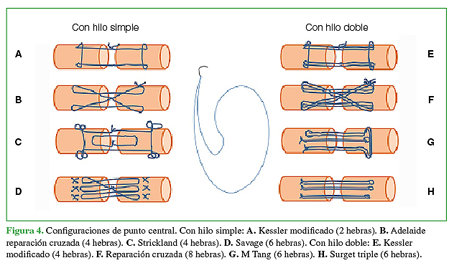 Configuraciones de punto central. Con hilo simple: A. Kessler modificado (2 hebras). B. Adelaide reparación cruzada (4 hebras). C. Strickland (4 hebras). D. Savage (6 hebras). Con hilo doble: E. Kessler modificado (4 hebras). F. Reparación cruzada (8 hebras). G. M Tang (6 hebras). H. Surget triple (6 hebras). 