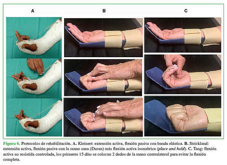 Protocolos de rehabilitación. A. Kleinert: extensión activa, flexión pasiva con banda elástica. B. Strickland: extensión activa, flexión pasiva con la mano sana (Duran) más flexión activa isométrica (place and hold). C. Tang: flexión activa no resistida controlada, los primeros 15 días se colocan 2 dedos de la mano contralateral para evitar la flexión completa. 