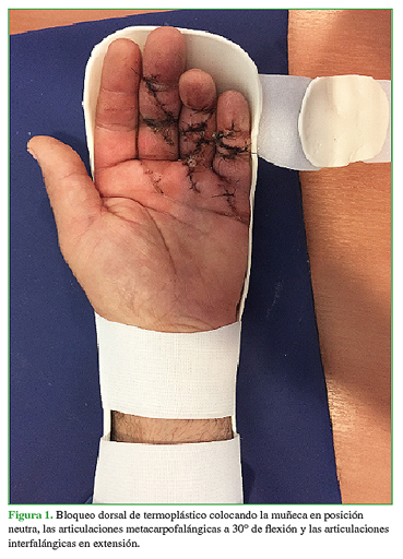 Bloqueo dorsal de termoplástico colocando la muñeca en posición neutra, las articulaciones metacarpofalángicas a 30° de flexión y las articulaciones interfalángicas en extensión.