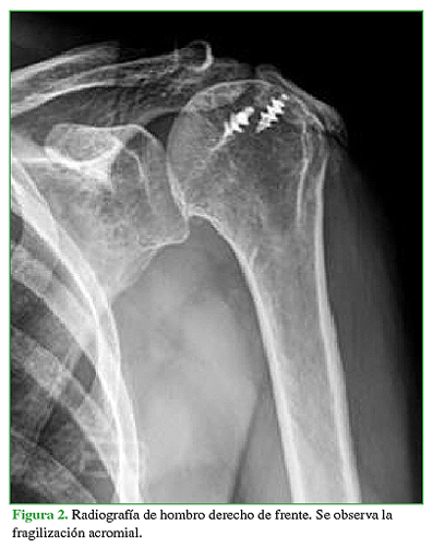 Radiografía de hombro derecho de frente. Se observa la fragilización acromial. 