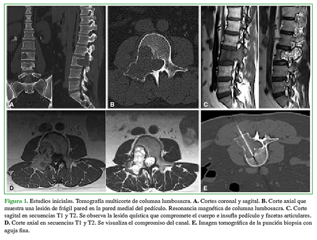 Estudios iniciales. Tomografía multicorte de columna lumbosacra. A. Corte coronal y sagital. B. Corte axial que muestra una lesión de frágil pared en la pared medial del pedículo. Resonancia magnética de columna lumbosacra. C. Corte sagital en secuencias T1 y T2. Se observa la lesión quística que compromete el cuerpo e insufla pedículo y facetas articulares. D. Corte axial en secuencias T1 y T2. Se visualiza el compromiso del canal. E. Imagen tomográfica de la punción biopsia con aguja fina.  
