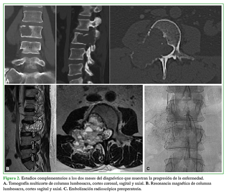 Estudios complementarios a los dos meses del diagnóstico que muestran la progresión de la enfermedad. A. Tomografía multicorte de columna lumbosacra, cortes coronal, sagital y axial. B. Resonancia magnética de columna lumbosacra, cortes sagital y axial. C. Embolización radioscópica preoperatoria.
