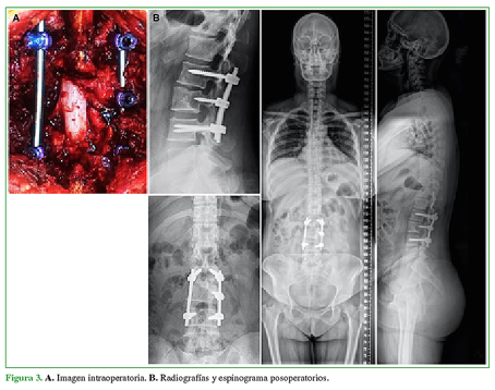 A. Imagen intraoperatoria. B. Radiografías y espinograma posoperatorios. 