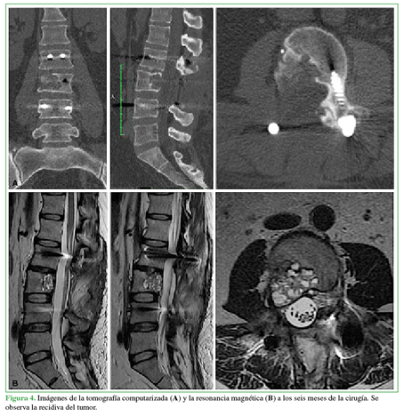 Imágenes de la tomografía computarizada (A) y la resonancia magnética (B) a los séis meses de la cirugía. Se observa la recidiva del tumor. 