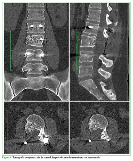Tomografía computarizada de control después del año de tratamiento con denosumab.
