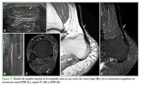 Tendón de Aquiles normal en la ecografía tanto en eje corto (A) como largo (B) y en la resonancia magnética en secuencias axial STIR (C), sagital T1 (D) y STIR (E).