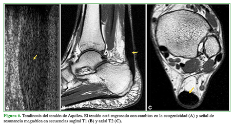 Tendinosis del tendón de Aquiles. El tendón está engrosado con cambios en la ecogenicidad (A) y señal de resonancia magnética en secuencias sagital T1(B) y axial T2(C). 