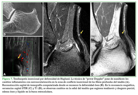 Tendinopatía insercional por deformidad de Haglund. La técnica de "power Doppler" pone de manifiesto los cambios inflamatorios con neovascularización en la zona de conflicto insercional de las fibras profundas del tendón (A). Reconstrucción sagital de tomografía computarizada donde se reconoce la deformidad ósea (B). En la resonancia magnética, secuencias sagital STIR (C) y T1(D), se observan cambios en la señal del tendón que sugieren tendinosis y desgarro parcial, edema óseo y líquido en la bursa retrocalcánea.