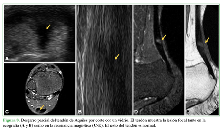 Desgarro parcial del Tendón de Aquiles por corte con un vidrio. El tendón muestra la lesión focal tanto en la ecografía (A y B) como en la resonancia magnética (C- E). El resto del tendón es normal. 