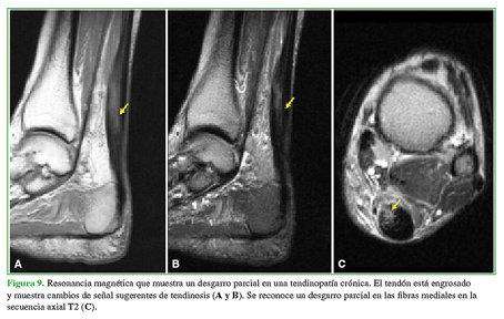 Resonancia magnética que muestra un desgarro parcial en una tendinopatía crónica. El tendón está engrosado y muestra cambios de señal sugerentes de tendinosis (A y B). Se reconoce un desgarro parcial en las fibras mediales en la secuencia axial T2 (C). 