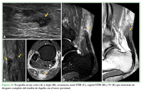 Ecografía en eje corto (A) y largo (B), secuencias axial STIR (C), sagital STIR (D) y T1(E) que muestran un desgarro completo del tendón de Aquiles en el tercio proximal. 