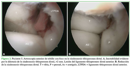 Paciente 5. Artroscopia anterior de tobillo con foco en la sindesmosis tibioperonea distal. A. Inestabilidad evidente por la diástasis de la sindesmosis tibioperonea distal, >2mm. Lesión del ligamento tibioperoneo distal anterior. B. Reducción de la sindesmosis tibioperonea distal. T=tibia, P=peroné, As=astrágalo, LTPDA=ligamento tibioperoneo distal anterior. 