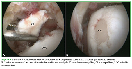 Paciente 5. Artroscopia anterior de tobillo. A. Cuerpo libre condral intrarticular que requirió exéresis. B. Lesión osteocondral en la carilla articular medial del astrágalo. DAs=domo astragalino, Cl=cuerpo libre, LOC=lesión osteocondral
