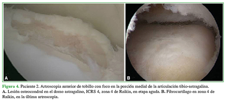 Paciente 2. Artroscopía anterior de tobillo con foco en la porción medial de la articulación tibio-astragalina. A. Lesión osteocondral en el domo astragalino, ICRS 4, zona 4 de Raikin, en etapa aguda. B. Fibrocartílago en zona 4 de Raikin, en la última artroscopía.