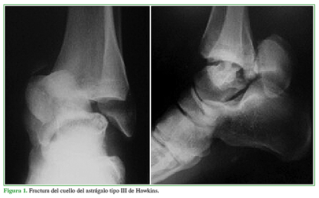 Fractura del cuello del astrágalo tipo III de Hawkins.