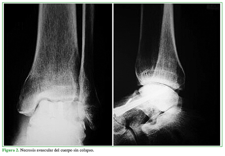 Necrosis avascular del cuerpo sin colapso.
