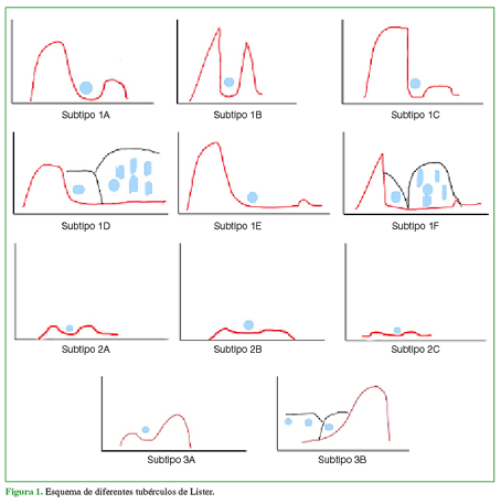Esquema de diferentes tubérculos de Lister