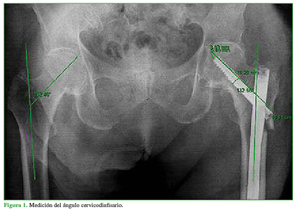 Medición del ángulo cervicodiafisario.