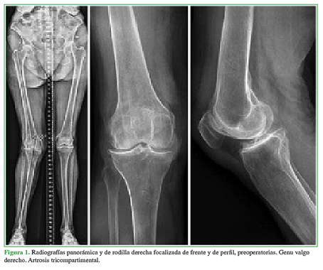 Radiografías panorámica y de rodilla derecha focalizada de frente y de perfil, preoperatorias. Genu valgo derecho. Artrosis tricompartimental.  
