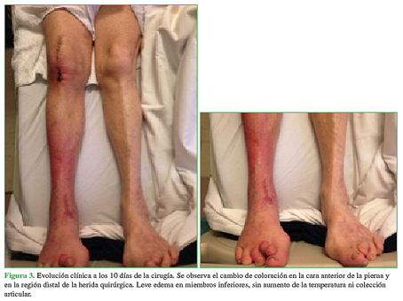 Evolución clínica a los 10 días de la cirugía. Se observa el cambio de coloración en la cara anterior de la pierna y en la región distal de la herida quirúrgica. Leve edema en miembros inferiores, sin aumento de la temperatura ni colección articular.